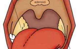 tonsillite  rimedi naturali. gola