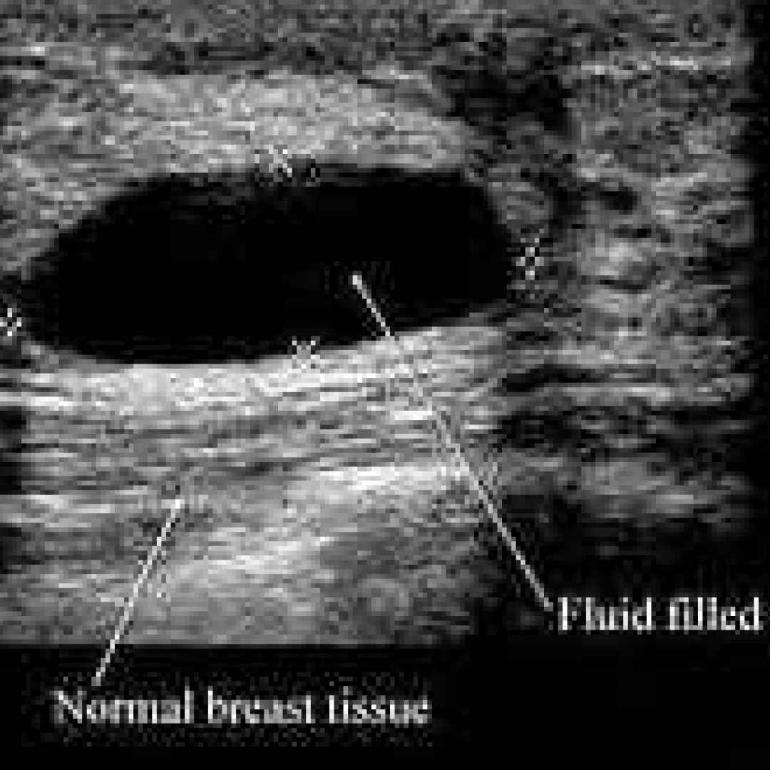 ecografia mammaria  fibroadenoma tumore