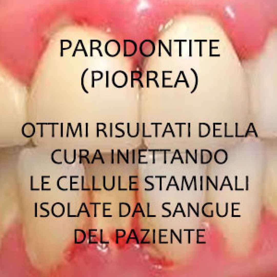 piorrea parodontite dentisti croazia