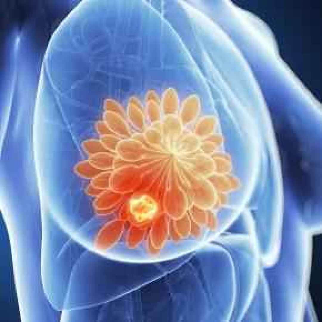 tumore al seno  tumori