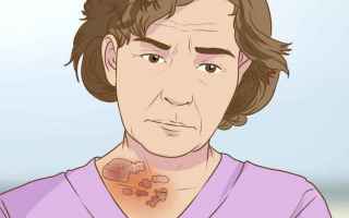 Medicina: fuoco di santantonio  herpes zoster