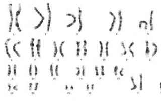 La sindrome di Klinefelter è una malattia genetica caratterizzata da unanomalia cromosomica in cui 