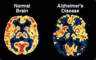 Alimentazione: alzheimer  epilessia  chetoni