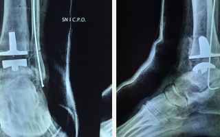 Medicina: intervento caviglia  protesi caviglia