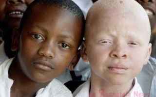 albino  ucciso ragazzo  mozambico