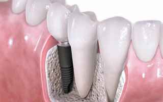 Medicina: impianti dentali  implantologia dentale