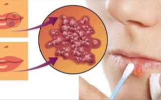 I 7 rimedi naturali per contrastare l’herpes labiale in brevissimo tempo