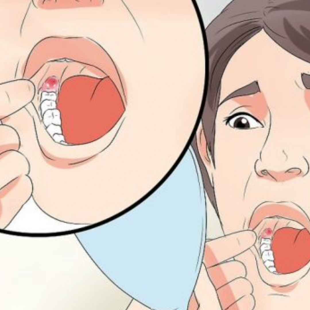 dente del giudizio  estrazione dente