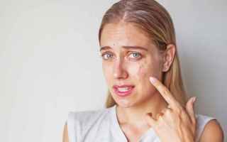 Bellezza: brufoli  acne  cura  salute