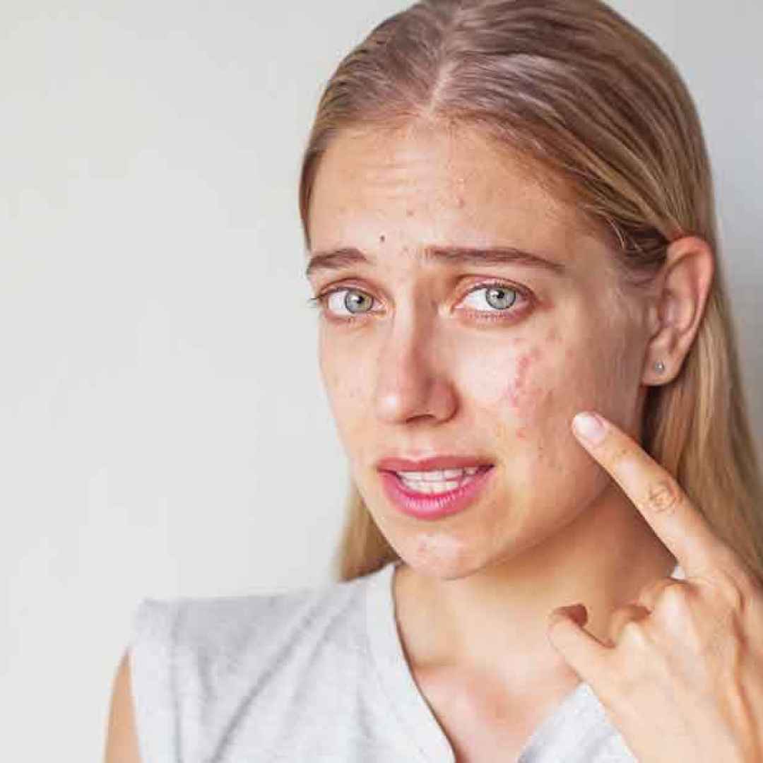 brufoli  acne  cura  salute