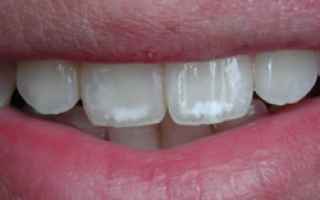 fluorosi  denti  macchie  bianche
