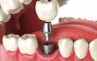 Medicina: impianto  dentale