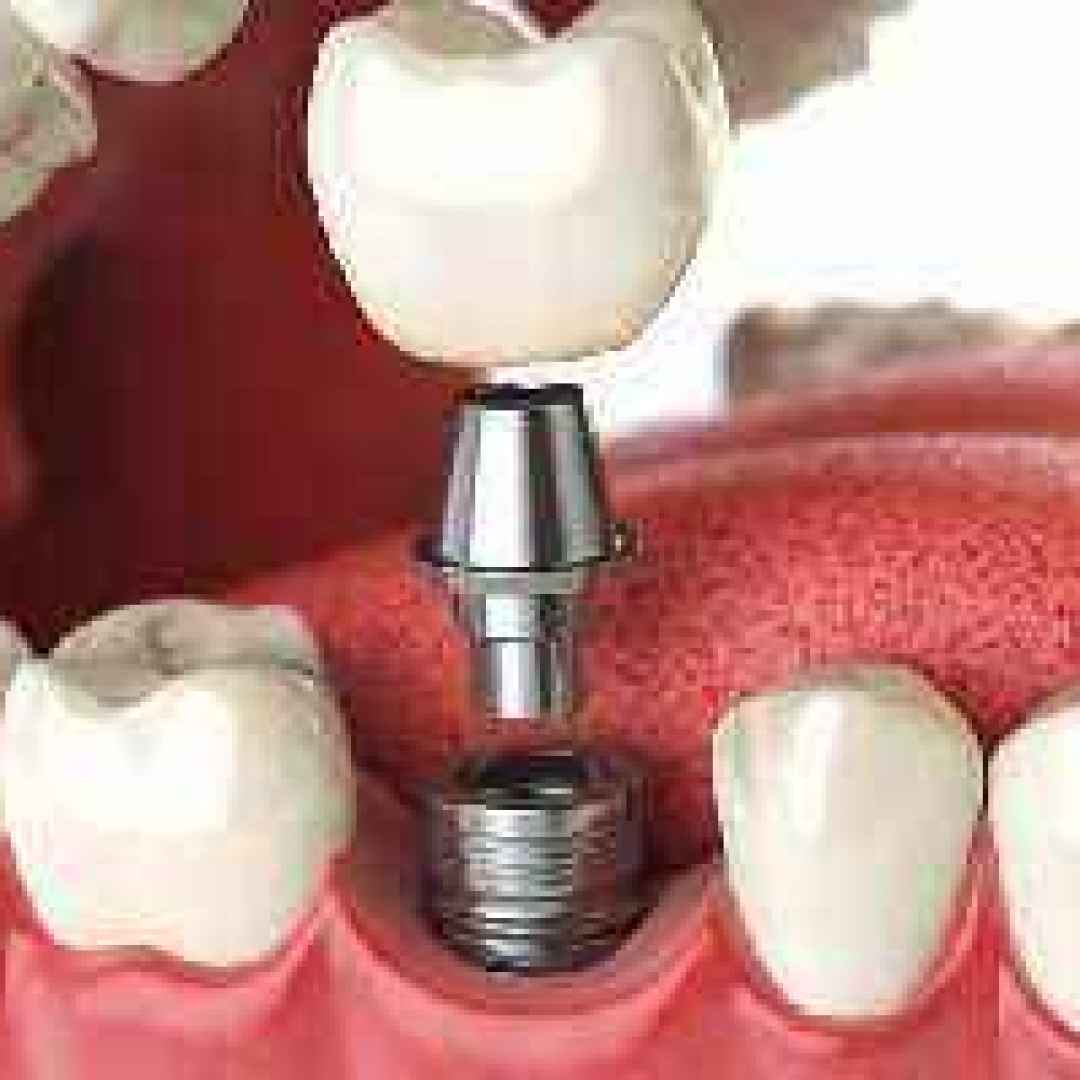 impianto  dentale