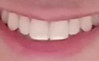 macchie  bianche  denti