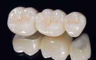 corone  dentali  dentista  roma
