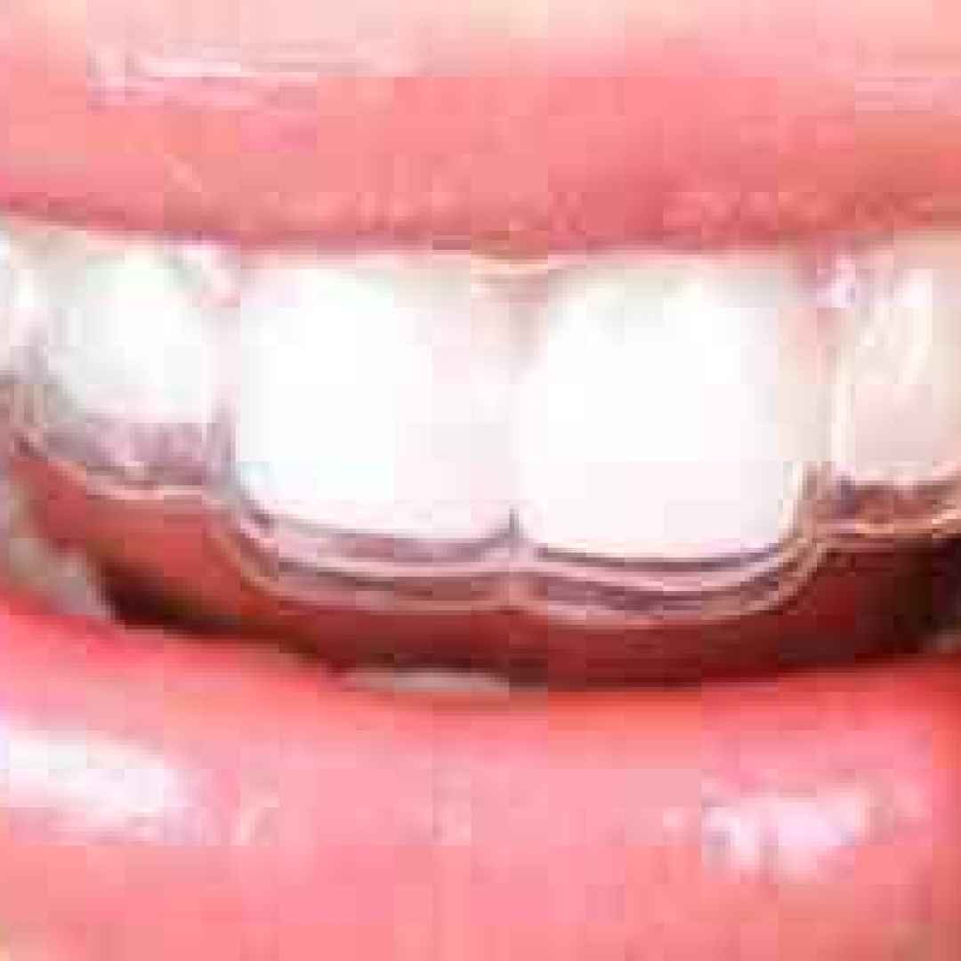 bite  placca  trasparente  denti