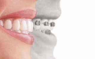 Bellezza: apparecchi  denti  ortodontici