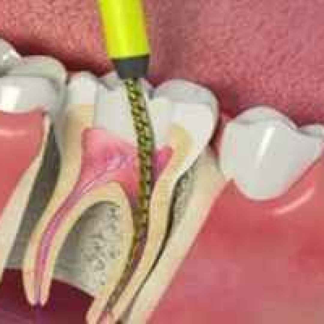 Эндодонтическое перелечивание зубов