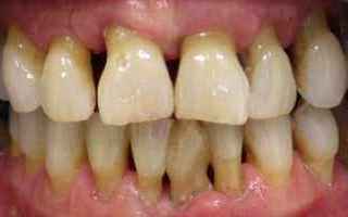 Non tutti sanno che uno dei problemi piu ricorrenti nei pazienti odontoiatrici e la Parodontite, ed 