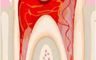 La pulpite è un processo infiammatorio della polpa dentaria. Con "polpa dentaria" si intende la par