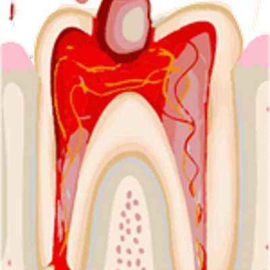 La pulpite acuta un infiammazione del tessuto interno al dente