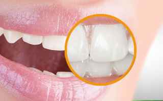 macchie bianche  denti  fluorosi