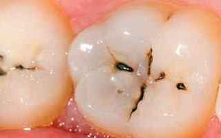 Medicina: cavitazione  dente  carie dentaria