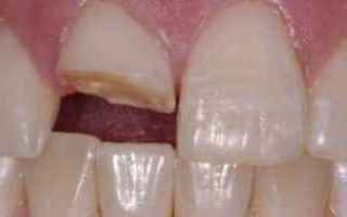 La ricostruzione del dente: come funziona e quando si può fare