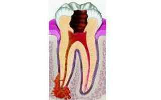 Medicina: granuloma  dentale  apicale