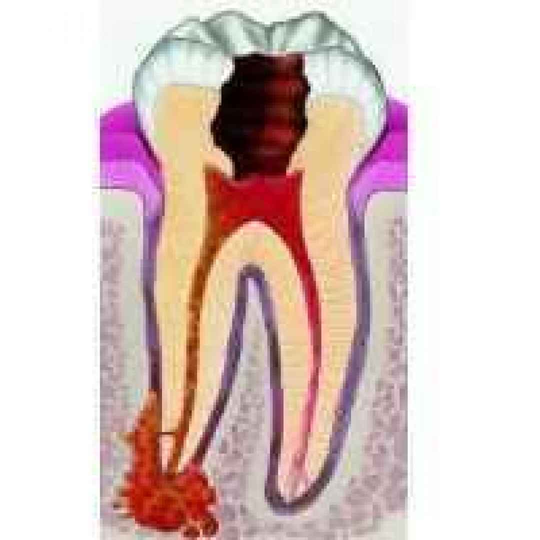 granuloma  dentale  apicale