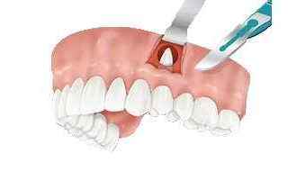 apicetomia estrazione chirurgia dente