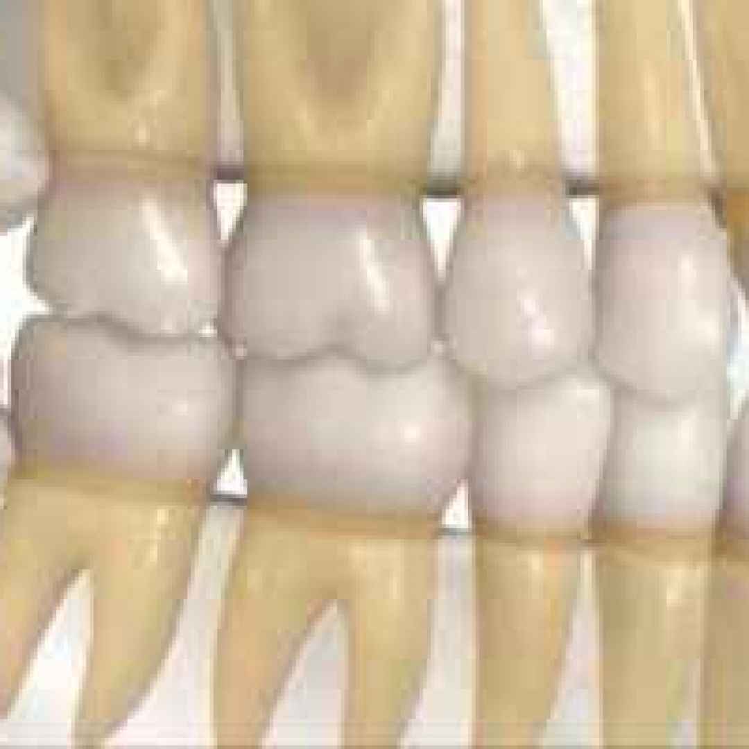 denti giudizio estrazione quando dente