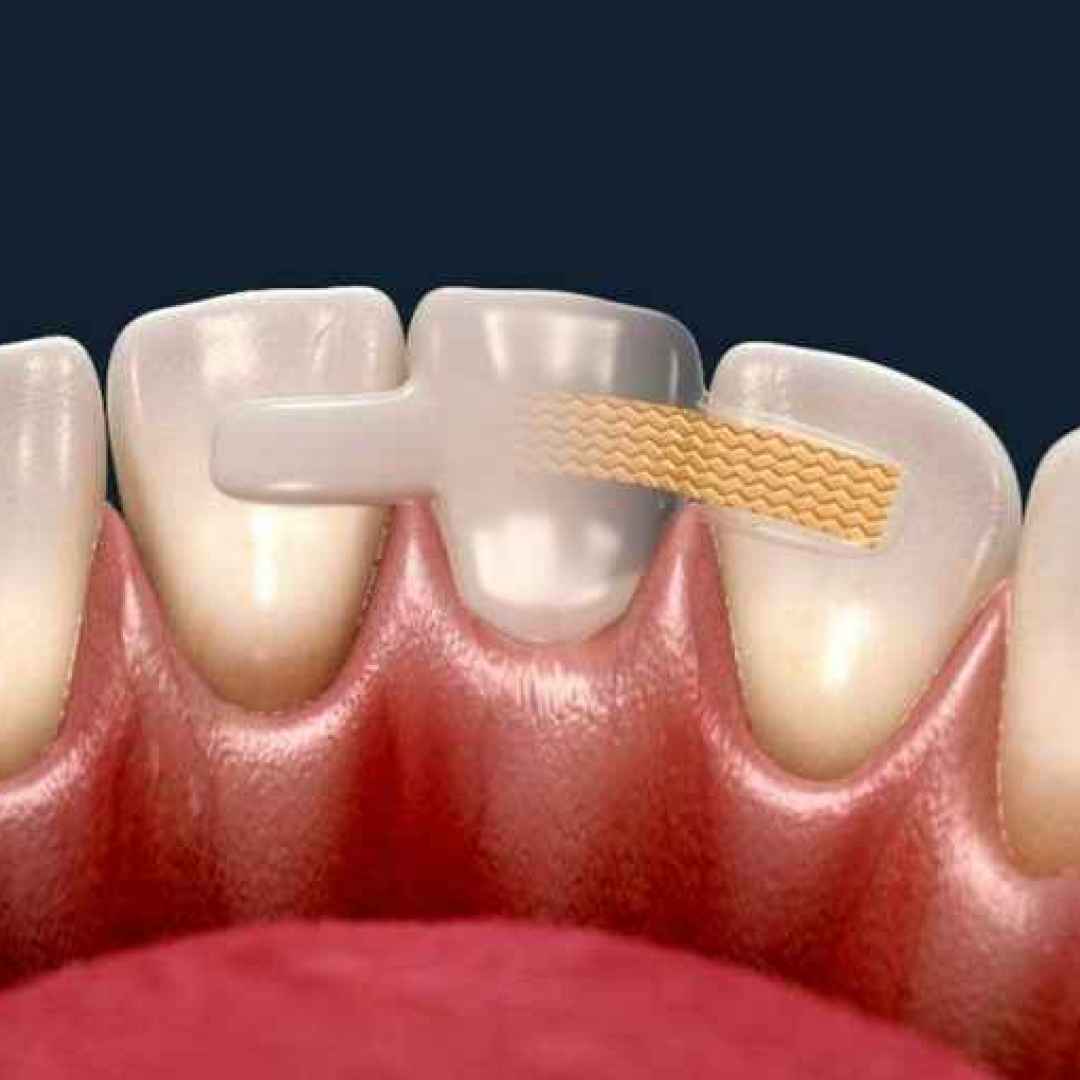 Le cause del diastema dentale lo spazio tra i denti