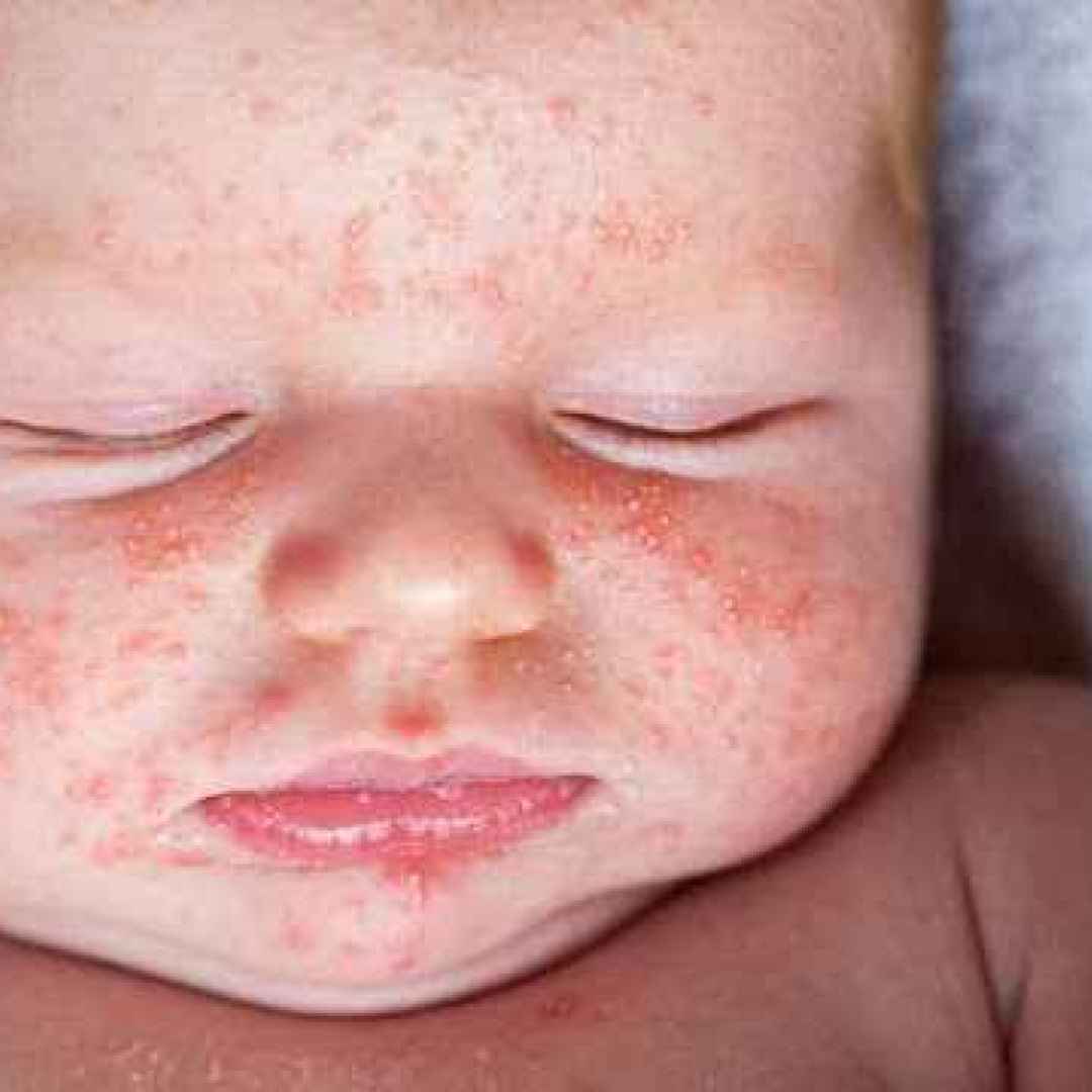 lassativi  neonati  allergie