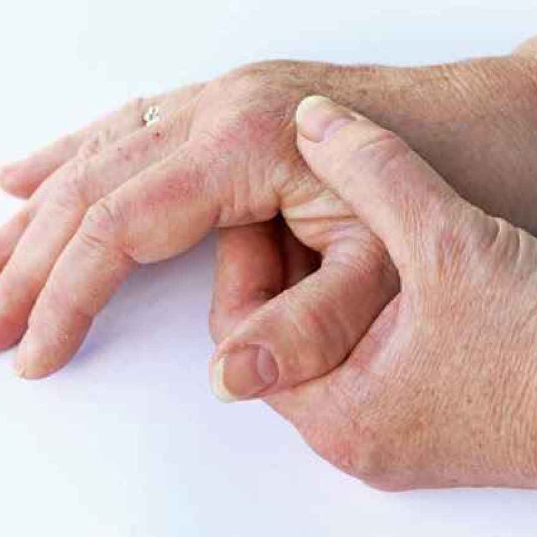 malattie-autoimmuni  artrite-reumatoide