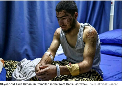 La foto mostra Awis Himan, 18 anni, il volto tumefatto ed il corpo pieno di graffi e lividi per l'aggressione subita dai coloni Israeliani illegali in Cisgiordania e le forze militari e di polizia israeliane 